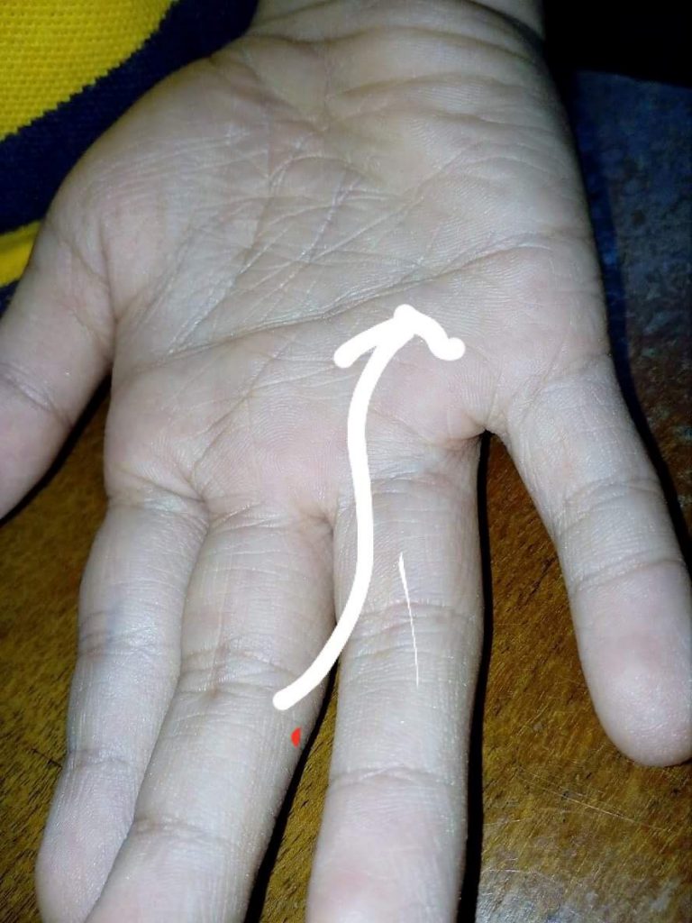 Signs of Down Syndrome and Life Expectancy Pangga ta Ikaw