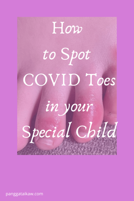 What are COVID toes?